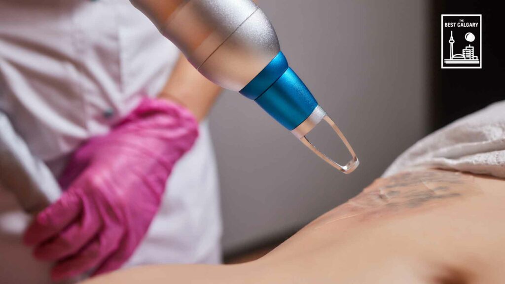 Best Tattoo Removal Services in Calgary