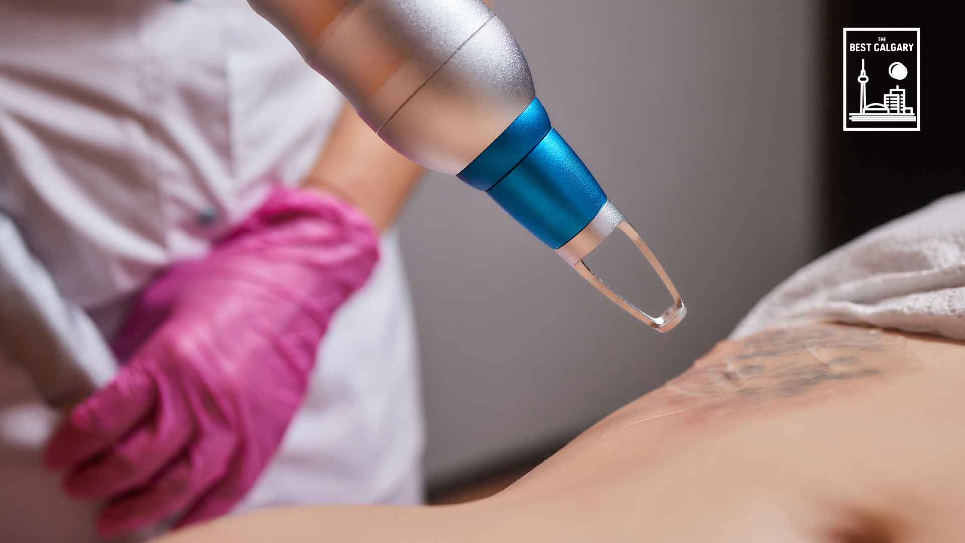 Best Tattoo Removal Services in Calgary
