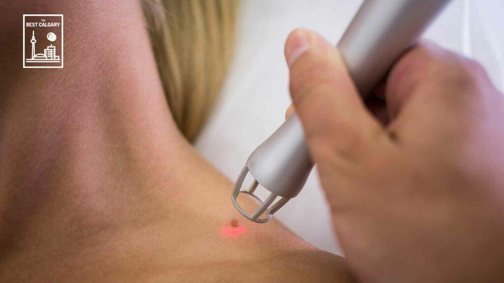Best Mole Removal in Calgary