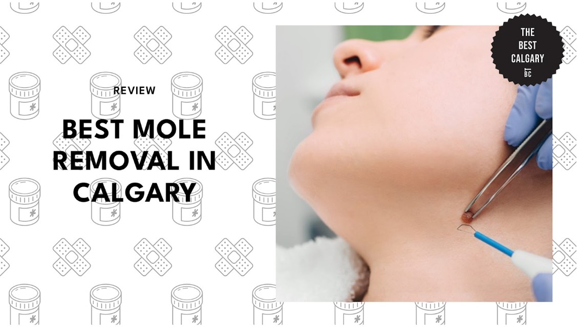Best Mole Removal in Calgary